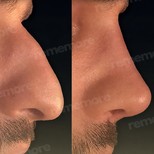نتائج عملية تجميل الأنف قبل وبعد في مستشفى ميموريال غوزتيبي، تحسين شكل الأنف