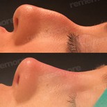 نتائج عملية تجميل الأنف قبل وبعد في مستشفى ميموريال غوزتيبي، تحسين شكل الأنف