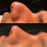 Resultados de rinoplastia antes y después en Memorial Göztepe Hospital, perfil nasal mejorado