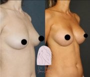 Before and after breast augmentation with fat transfer results at Dr. MED clinic