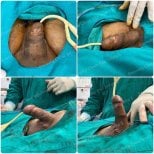 Before and after penile implant surgery results at ID Clinic Bangkok, visible enhancement achieved