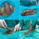 Penile implant surgery results at ID Clinic Bangkok – visible improvement in erectile function