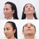 Before and after revision rhinoplasty results at Wansiri Hospital, improved nose contour