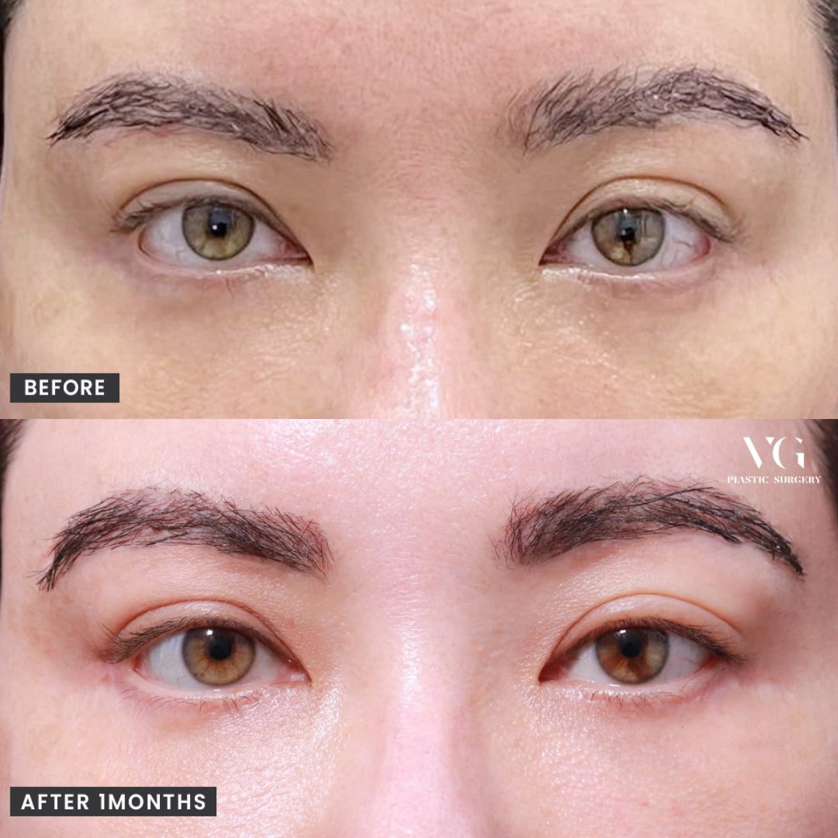 Resultados antes y después de cirugía cat eye (canthoplastia) en VG Plastic Surgery