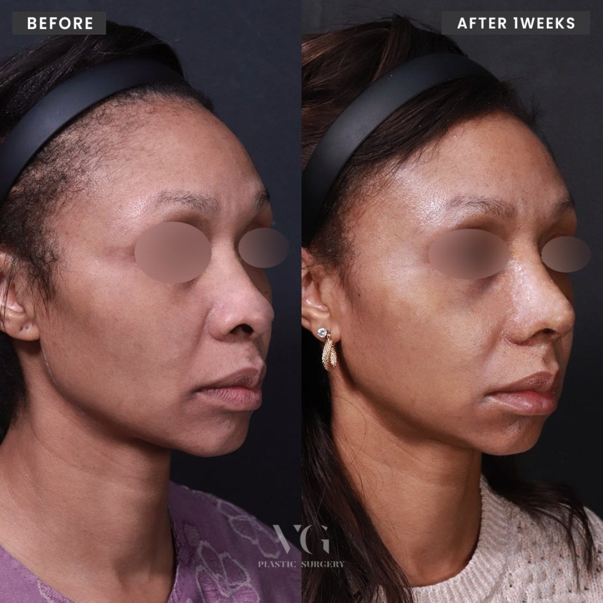 Resultados antes y después de rinoplastia étnica en VG Plastic Surgery, mejora de la nariz