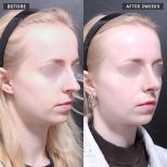 Resultados de rinoplastia antes y después en VG Plastic Surgery, remodelación nasal tras 2 semanas