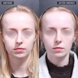 قبل وبعد عملية تجميل الأنف في VG Plastic Surgery، نتائج تعديل الأنف بعد أسبوعين