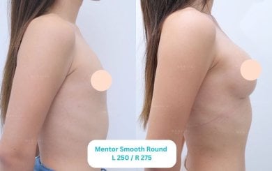 До и после увеличения груди в Wansiri Hospital, видимый результат увеличения объема