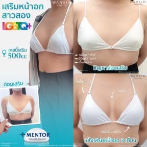 Результаты увеличения груди до и после в Wansiri Hospital, импланты Mentor 500cc