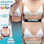 Результаты увеличения груди до и после в Wansiri Hospital, импланты Mentor 500cc