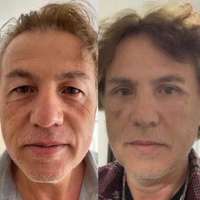 Vorher-nachher-Ergebnisse der Blepharoplastik in Prof. Furkan Karabekmez Klinik