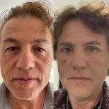 Vorher-nachher-Ergebnisse der Blepharoplastik in Prof. Furkan Karabekmez Klinik