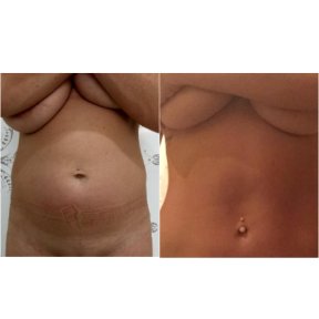 Liposuktion Vorher-Nachher-Ergebnis bei Istanbul Aesthetic Plastic Surgery Center, flacher Bauch