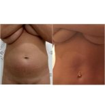 Liposuktion Vorher-Nachher-Ergebnis bei Istanbul Aesthetic Plastic Surgery Center, flacher Bauch