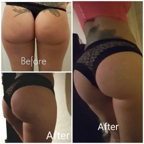 Результати до і після Brazilian Butt Lift в Istanbul Aesthetic Plastic Surgery Center