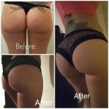 Результати до і після Brazilian Butt Lift в Istanbul Aesthetic Plastic Surgery Center