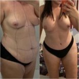 Vorher-nachher-Ergebnisse Mommy Makeover bei Istanbul Aesthetic Plastic Surgery Center, Körperkontur