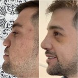 Vorher-nachher-Ergebnis der männlichen Nasenkorrektur bei Istanbul Aesthetic Plastic Surgery Center