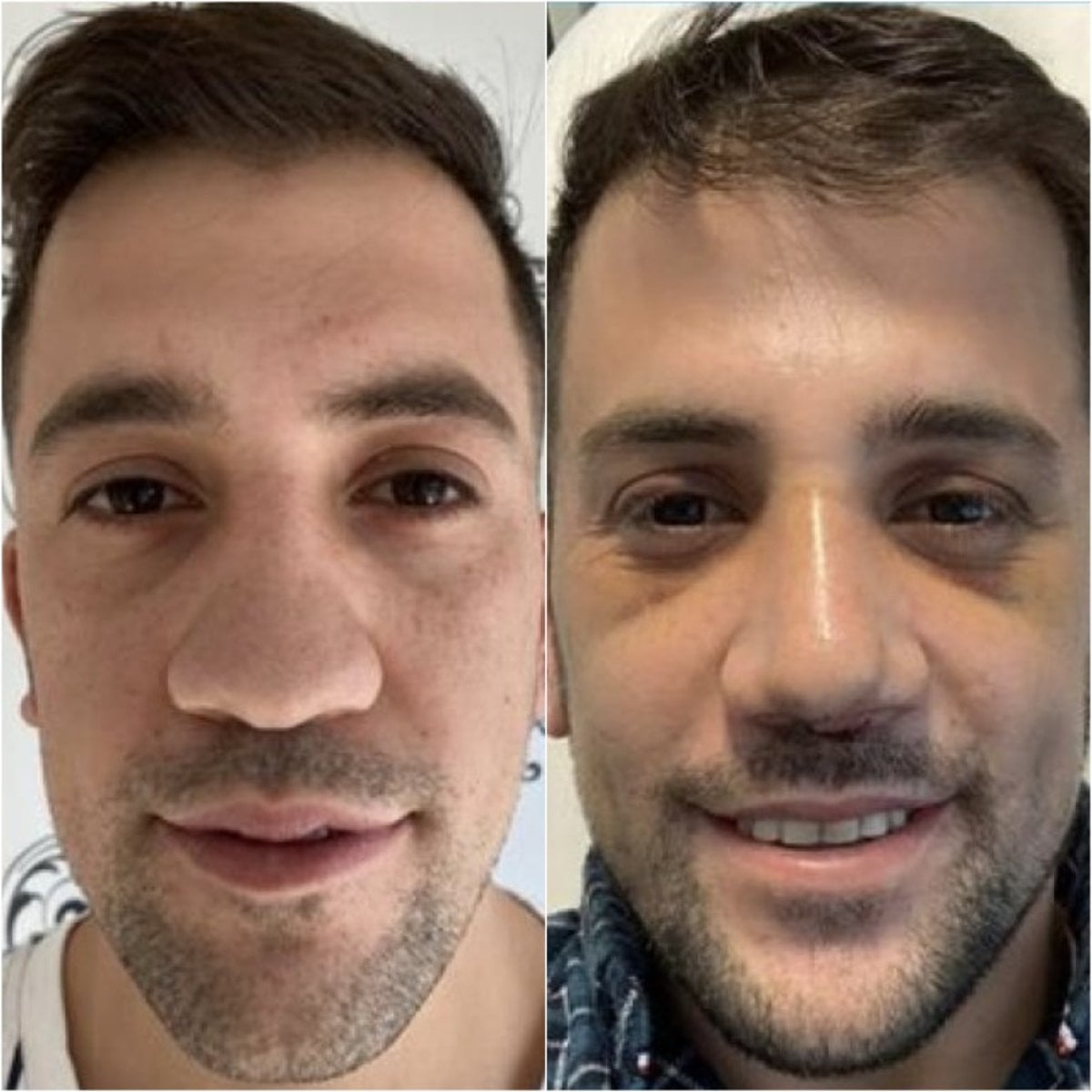 نتائج تجميل الأنف للرجال قبل وبعد في مركز إسطنبول لجراحة التجميل