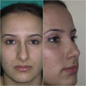Vorher-nachher-Rhinoplastik-Ergebnisse bei Istanbul Aesthetic Plastic Surgery Center, Nasenkorrektur