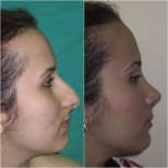 Vorher-nachher-Ergebnisse der Nasenkorrektur im Istanbul Aesthetic Plastic Surgery Center