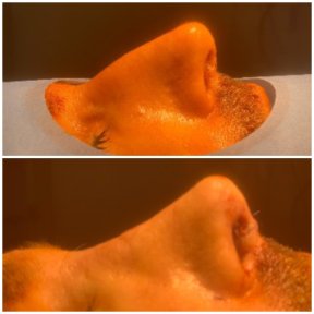 Vorher-nachher-Rhinoplastik-Ergebnis bei Istanbul Aesthetic Plastic Surgery Center, Nasenkorrektur