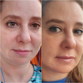 Vorher-nachher-Rhinoplastik-Ergebnisse bei Istanbul Aesthetic Plastic Surgery Center, verfeinerte Nase