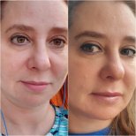 Vorher-nachher-Rhinoplastik-Ergebnisse bei Istanbul Aesthetic Plastic Surgery Center, verfeinerte Nase