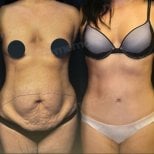 Before and after tummy tuck and liposuction results at Memorial Bahçelievler Hospital