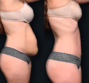 Before and after tummy tuck and liposuction results at Memorial Bahçelievler Hospital