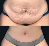 Before and after liposuction at Memorial Şişli Hospital, abdomen contouring result