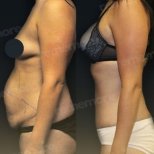 Before and after liposuction results at Memorial Şişli Hospital, improved abdominal contour