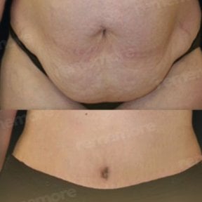 Before and after liposuction results at Memorial Şişli Hospital, improved abdominal contour