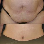 Before and after liposuction results at Memorial Şişli Hospital, improved abdominal contour