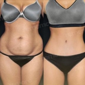 Before and after liposuction results at Memorial Şişli Hospital, improved abdominal contour