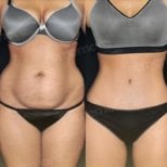 Before and after liposuction results at Memorial Şişli Hospital, improved abdominal contour