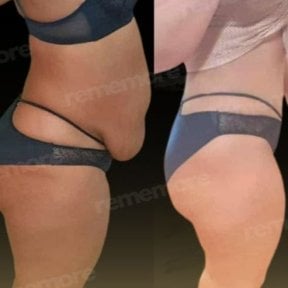 Before and after liposuction results at Memorial Şişli Hospital, improved abdominal contour