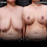 Foto sebelum dan sesudah Pengangkatan payudara oleh Dr. 