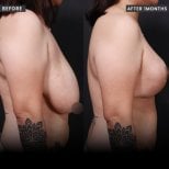 Foto sebelum dan sesudah Pengangkatan payudara oleh Dr. 