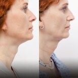 Before and after tracheal shave results at Wansiri Hospital, reduced Adam’s apple prominence