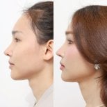 Before and after tracheal shave results at Wansiri Hospital – smoother neck contour