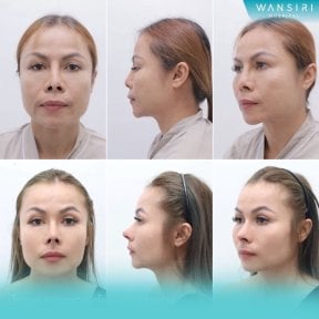 Before and after revision rhinoplasty results at Wansiri Hospital, improved nose shape