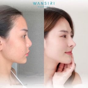 Before and after revision rhinoplasty result at Wansiri Hospital, improved nose profile