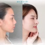 Before and after revision rhinoplasty result at Wansiri Hospital, improved nose profile