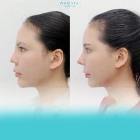 Before and after revision rhinoplasty result at Wansiri Hospital, improved nose profile