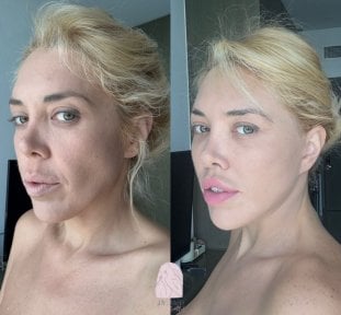 Efekty liftingu twarzy przed i po w Dr. MED – widoczne odmłodzenie i kontur