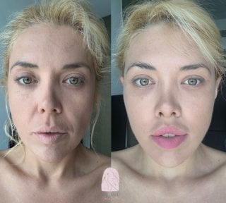 Efekty liftingu twarzy przed i po w Dr. MED – odmłodzenie i gładsza skóra