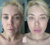 Efekty liftingu twarzy przed i po w Dr. MED – odmłodzenie i gładsza skóra