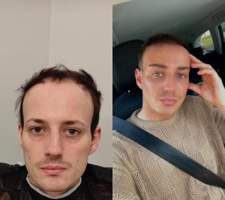 Stirnlift Vorher-Nachher-Ergebnisse bei Istanbul Aesthetic Plastic Surgery Center, Verjüngung