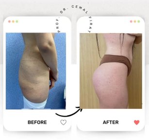 Vorher-nachher-Ergebnisse Brazilian Butt Lift im Medical Park Antalya Hospital Complex